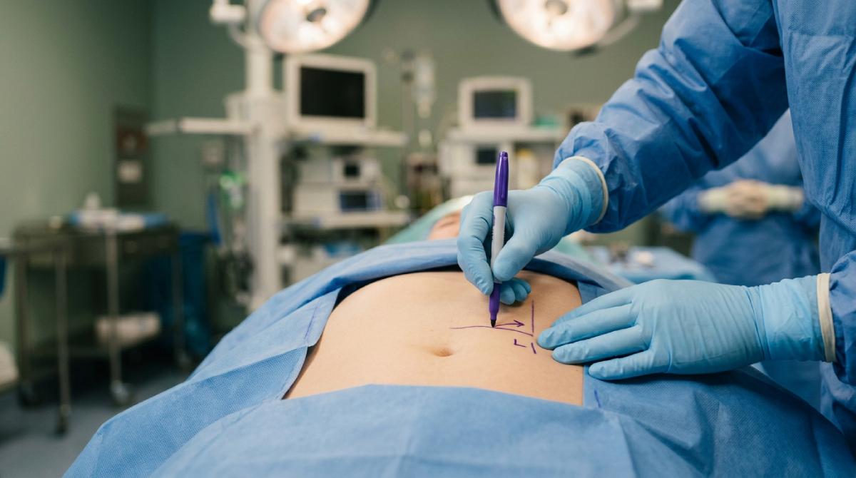 Abdominoplastia: qué es, procedimiento paso a paso y recuperación